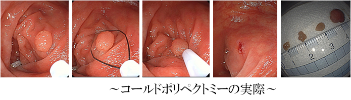 コールドポリペクトミーの実際