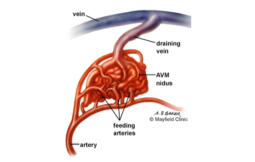 脳動静脈奇形に対するガンマナイフ治療