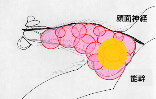 聴神経腫瘍に対するガンマナイフ治療計画