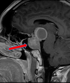 下垂体腫瘍のMRI画像
